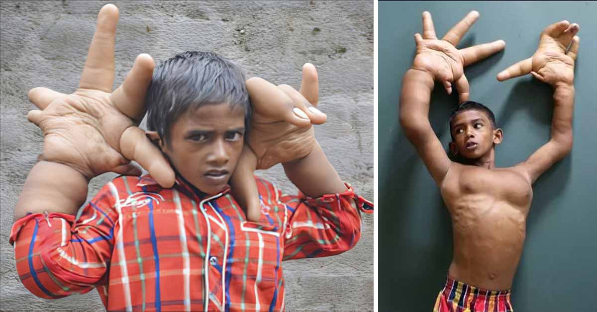 Boy with Giant Hands